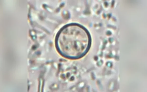US Cyclosporiasis Outbreak Spreads to 34 States