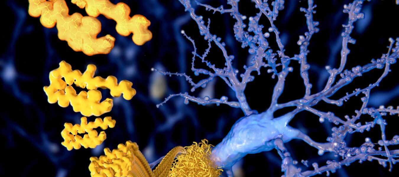 Cognitive Speed Training Reduces Dementia Risk by Clearing Brain Amyloid Cognitive Speed Training Reduces Dementia Risk by Clearing Brain Amyloid