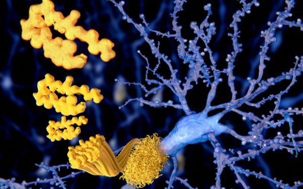 Cognitive Speed Training Reduces Dementia Risk by Clearing Brain Amyloid Cognitive Speed Training Reduces Dementia Risk by Clearing Brain Amyloid