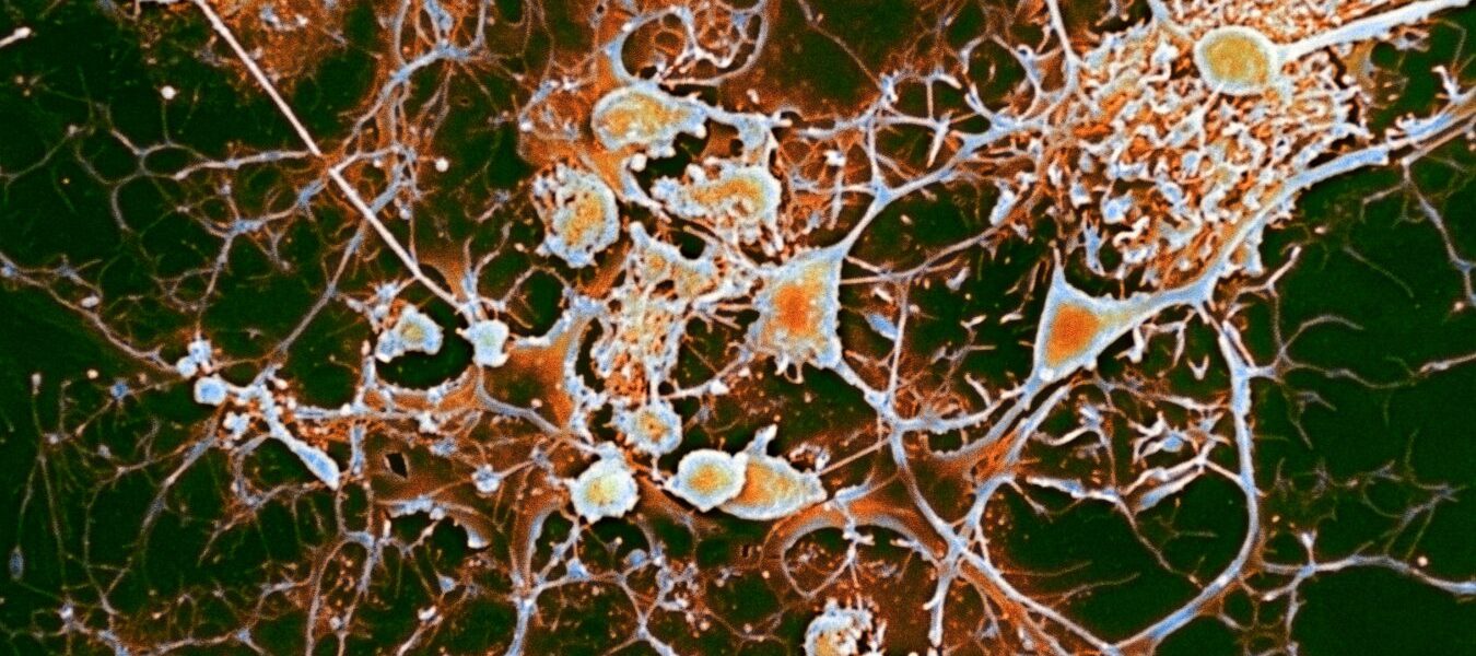 Antiviral drugs may offer best treatment for multiple sclerosis Antiviral drugs may offer best treatment for multiple sclerosis
