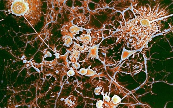 Antiviral drugs may offer best treatment for multiple sclerosis Antiviral drugs may offer best treatment for multiple sclerosis