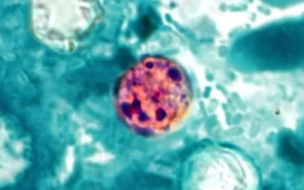 Cyclosporiasis Outbreak Spreads Across US States
