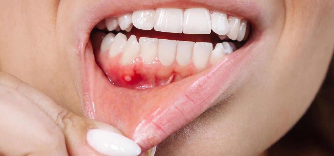 Rising Mouth Cancer Cases in Sindh Worry Health Experts