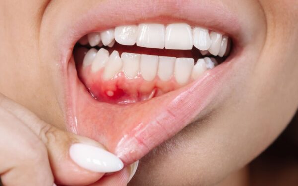 Rising Mouth Cancer Cases in Sindh Worry Health Experts Rising Mouth Cancer Cases in Sindh Worry Health Experts