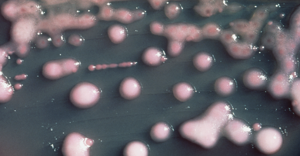 Woman’s UTI Bacteria Evolve, Invade Brain Causing Vision Loss
