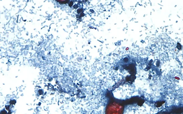 US Cyclosporiasis Outbreak Reaches Over 2,800 Cases US Cyclosporiasis Outbreak Reaches Over 2,800 Cases
