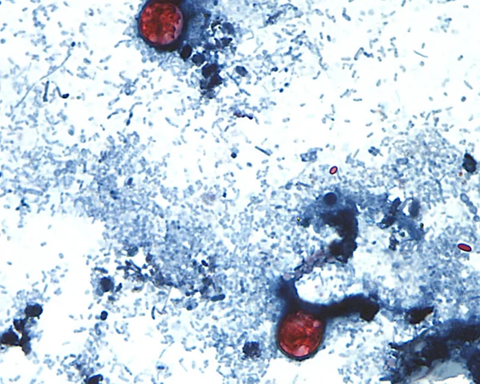 US Cyclosporiasis Outbreak Reaches Over 2,800 Cases