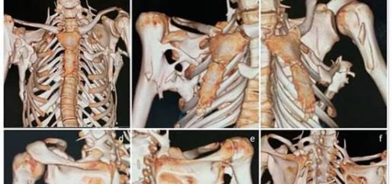 FDA Approves New Drug for Rare Bone Disorder